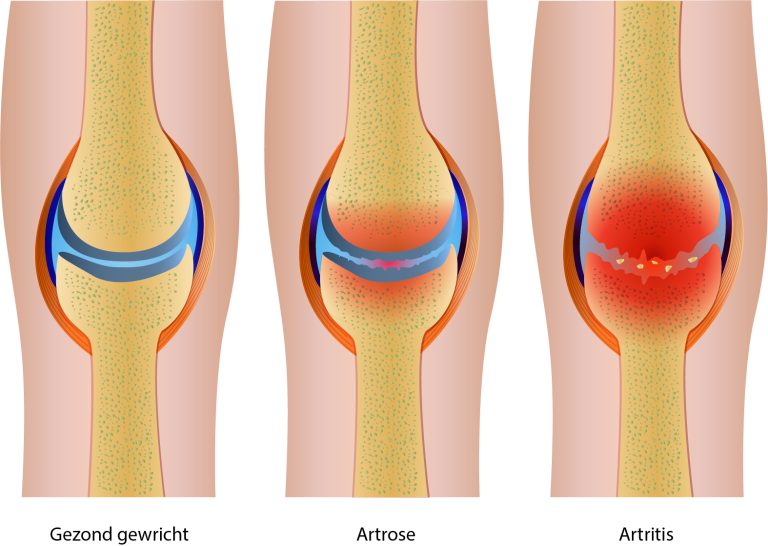 Glucosamine artrose artritis